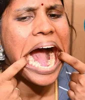 26 साल की महिला के मुंह में 38 दांतों का वर्ल्ड रिकॉर्ड, क्या ऐसे दांत निकलवा देने चाहिए?